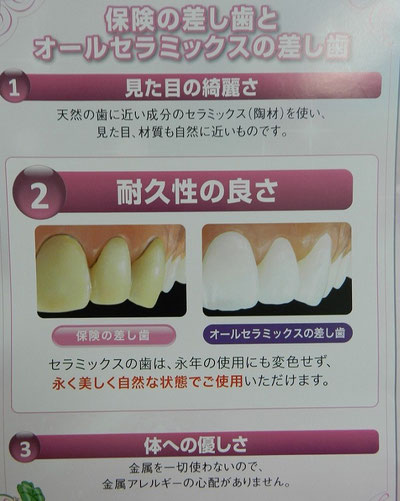 保険の差し歯とオールセラミックスの差し歯