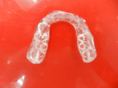 顎関節症治療用・歯ぎしり治療用マウスピース