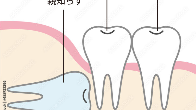 親知らずって抜かないとダメ？残すべきかどうかの見極めポイントとは？