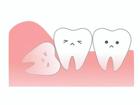 歯ぐきに埋まった“埋伏歯”ってなに？どうやって抜くの？