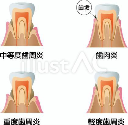 「歯肉炎」と「歯周炎」の違い