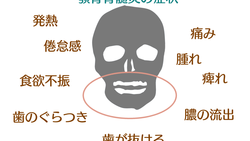歯の根の感染があごの骨まで進行してしまう病気？