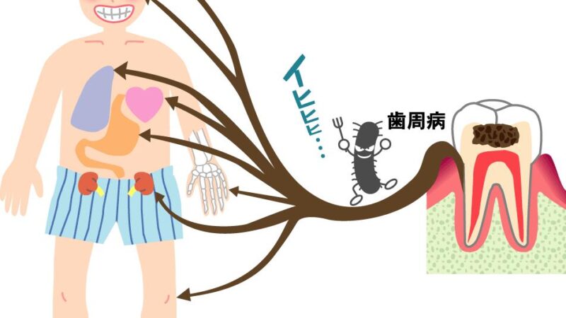 心臓病や動脈硬化と歯周病の関係