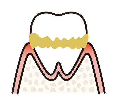 歯肉炎と歯周炎の決定的な違い